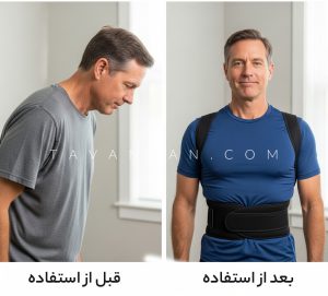 قوزبند چیست و چرا باید استفاده کرد ( 5 دلیل) بل و بعد استفاده از قوزبند برای اصلاح قوز کمر