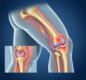 سبک زندگی و پیشگیری از مشکلات مفاصل سبک زندگی و پیشگیری از مشکلات مفاصل