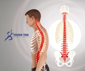 بریس توراکولومبوساکرال TLSO چیست و چه کاربردی دارد؟