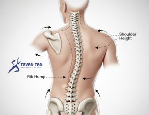 بریس توراکولومبوساکرال TLSO چیست و چه کاربردی دارد؟