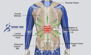 بریس توراکولومبوساکرال TLSO چیست و چه کاربردی دارد؟